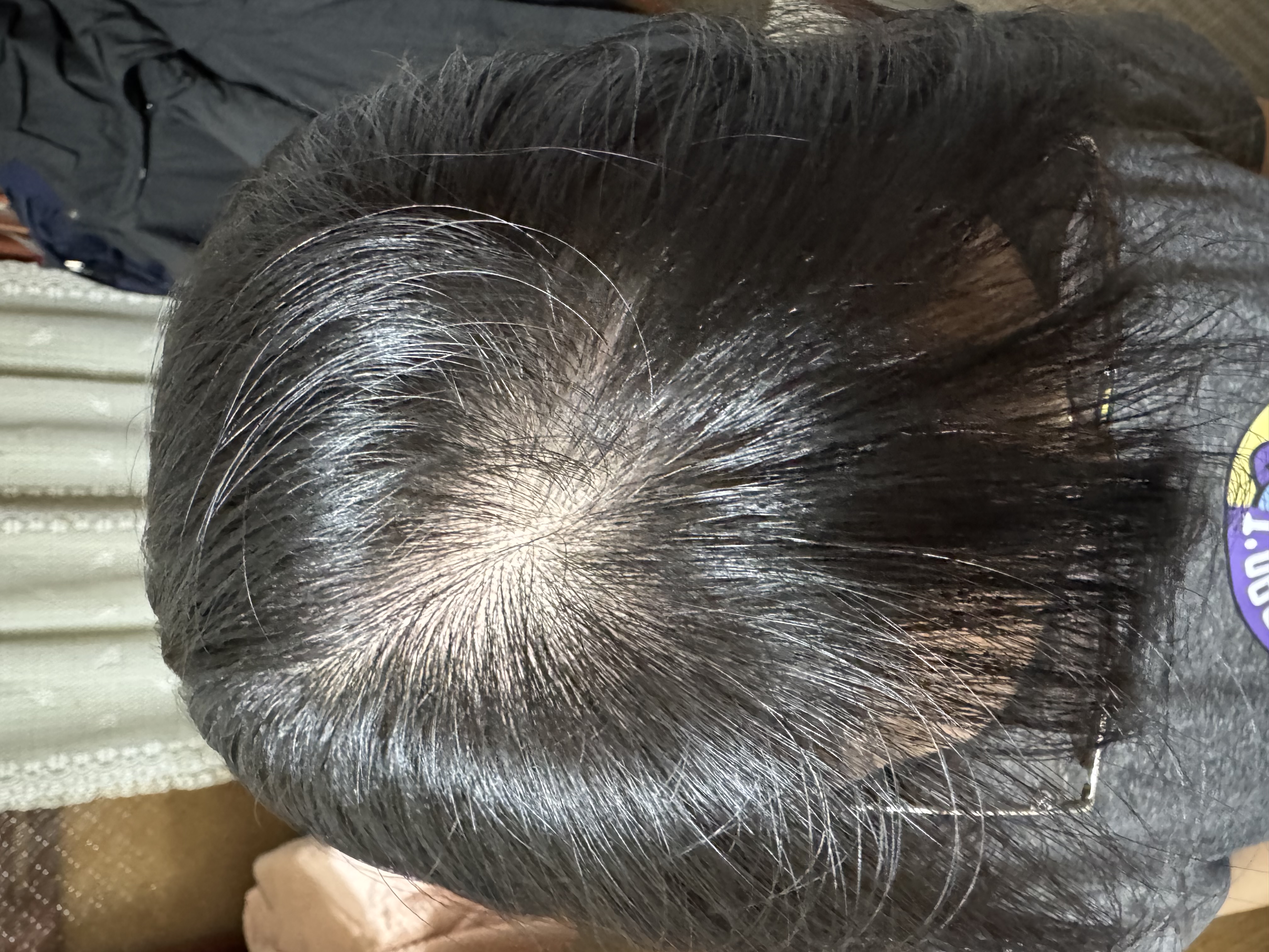 頭頂稀疏